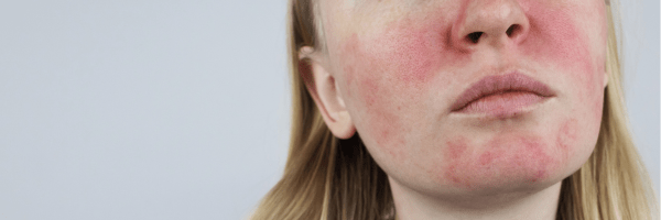 Acne vs. Rosacea: What's Really Going On With Your Skin? - KEAPURE